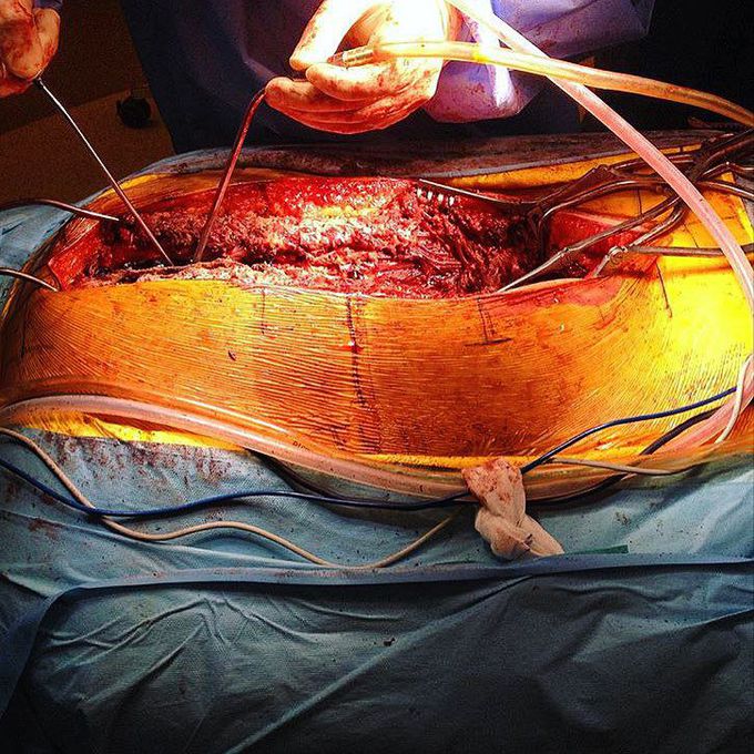 Scoliosis surgery