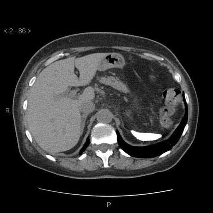 Autosplenectomy