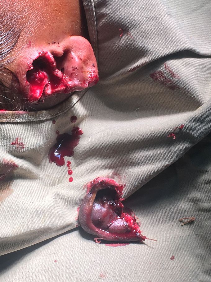 Naccross of the ear lobe adter a dog bite