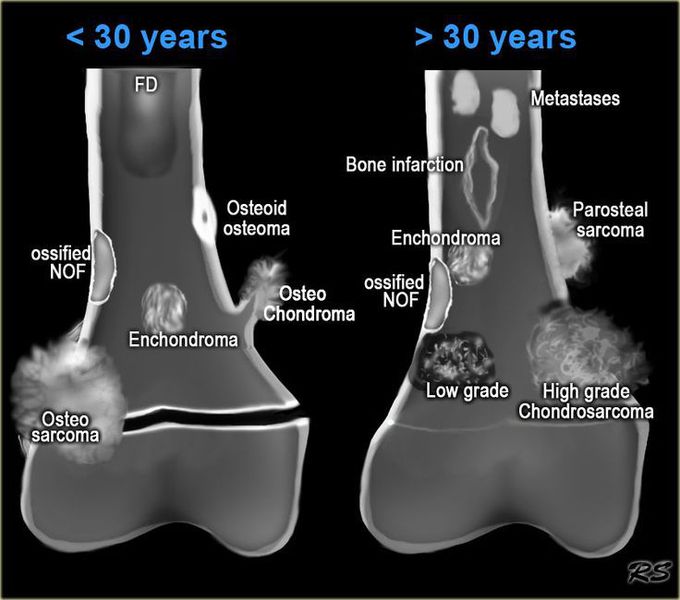 Bone Tumors - location & age