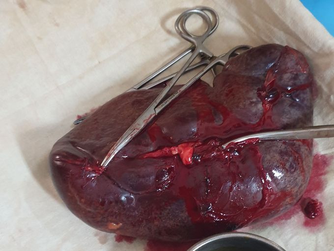 Indication of Surgery- Splenomegaly with Hypersplenism    Name of Surgery- Open Splenectomy