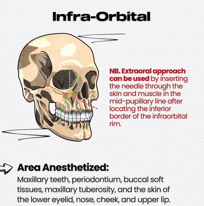 Maxillary Local Anesthesia IX