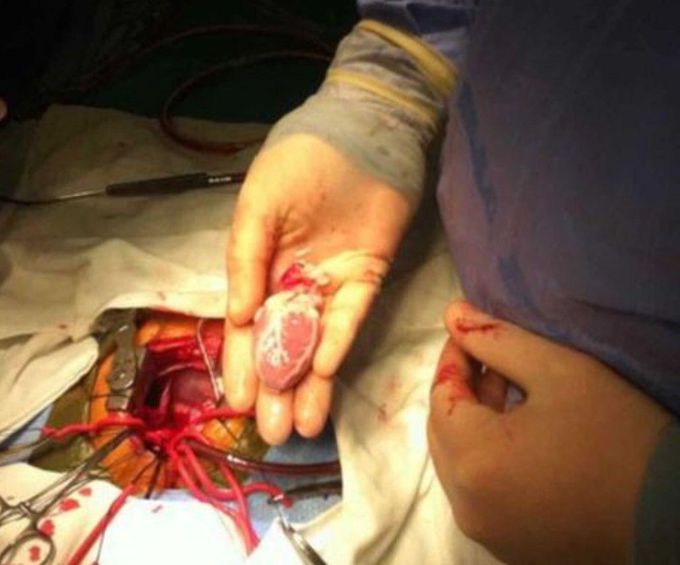 Pediatric heart transplant