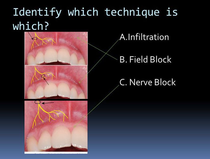 local-anesthetic-injection-techniques-medizzy