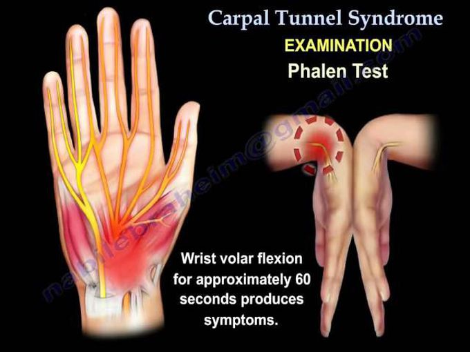 Carpal Tunnel Syndrome