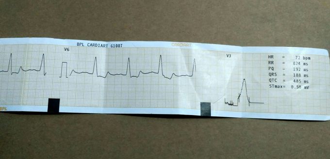 What is problem in this ECG?