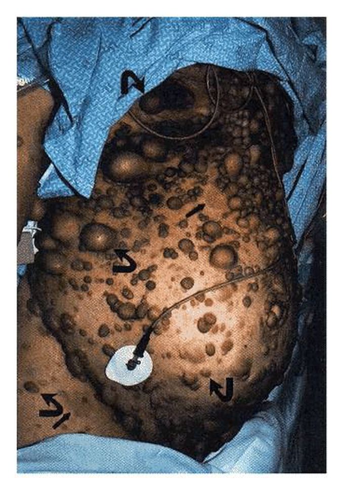 Neurofibromatosis Type 1