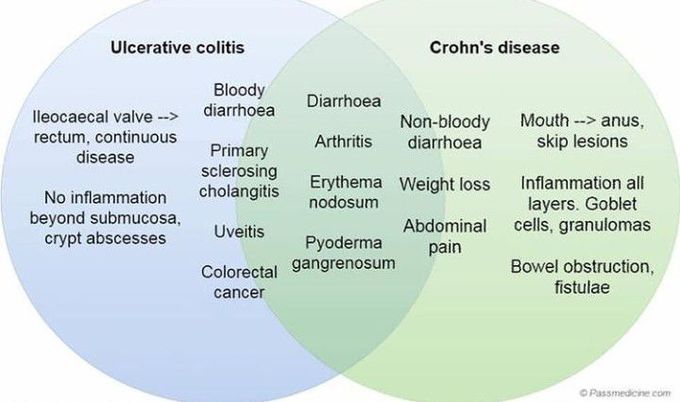 Crohn's Disease Vs Ulcerative Colitis