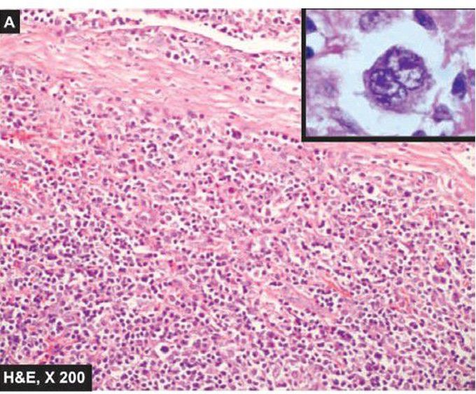 Hodgkin’s disease