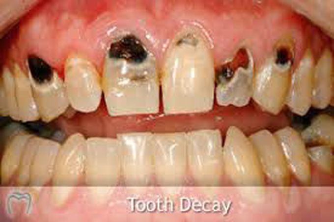 Signs of tooth decay