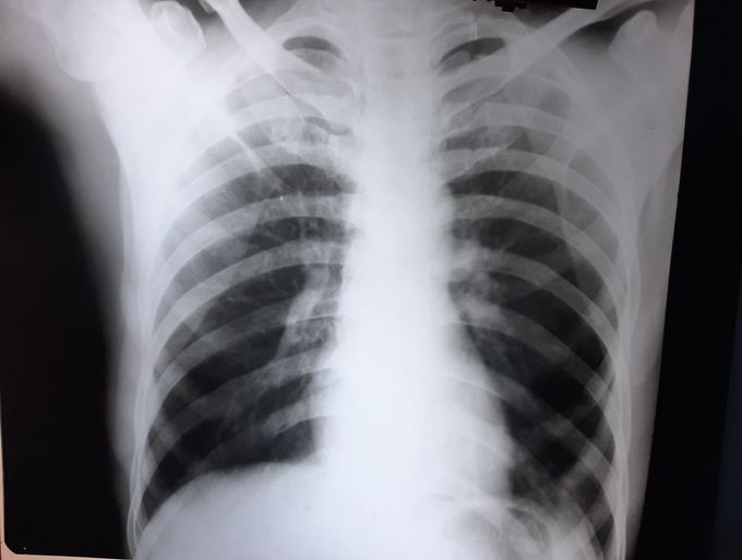 Chest x ray