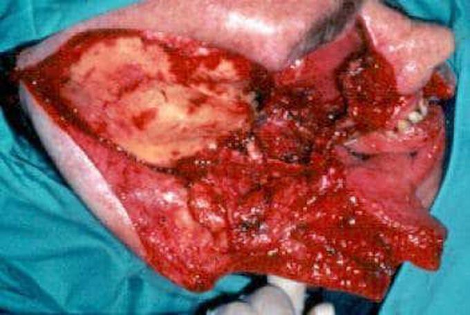 Mucormycosis treatment