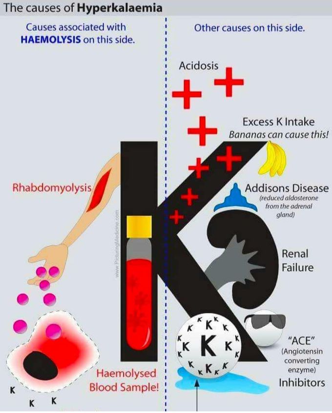 Hyperkalemia