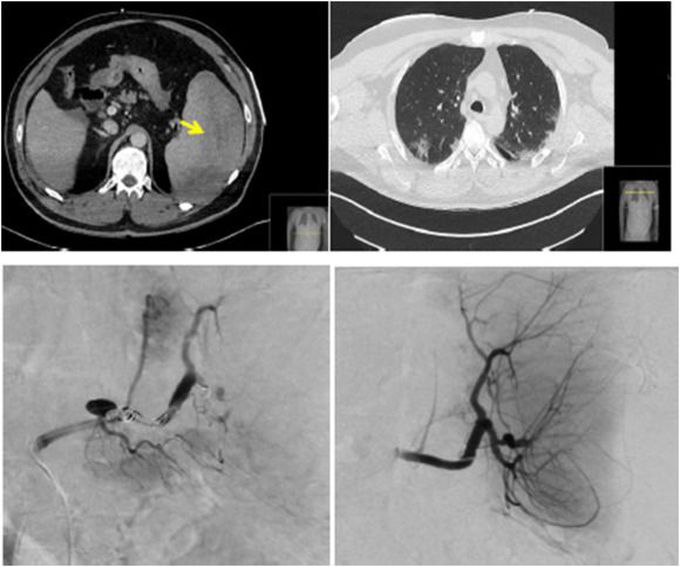 Atraumatic Rupture of Spleen in CoVid-19 Patient