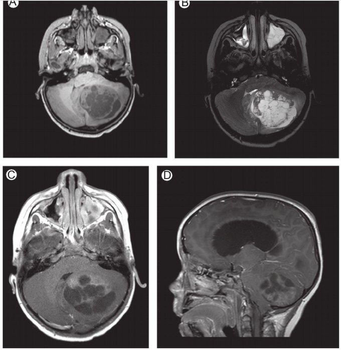 Juvenile polycystic astrocytoma - MEDizzy