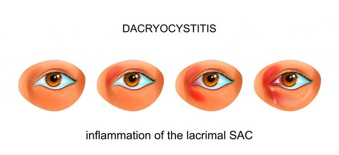 Acute dacryocystitis