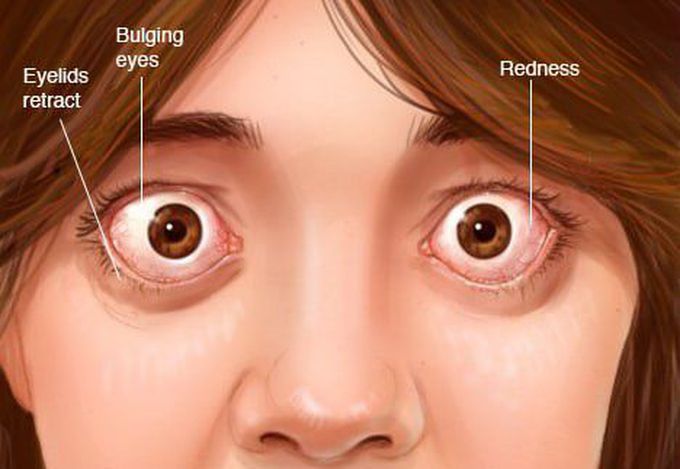 Graves disease opthamological complications