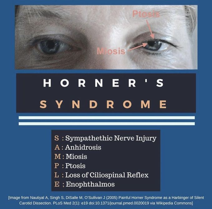 Horner's syndrome - MEDizzy