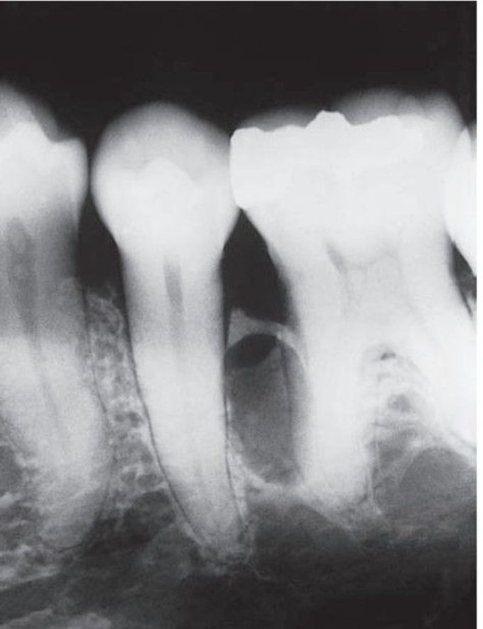 Lateral periodontal cyst associated with 2nd premolar