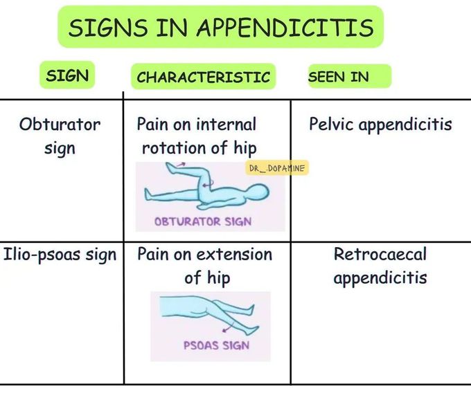 Signs in Appendicitis II