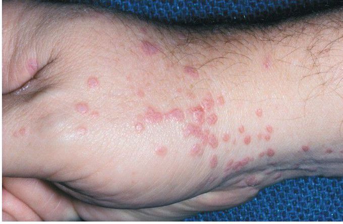 Lichen Planus.