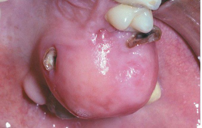 Peripheral Ossifying Fibroma