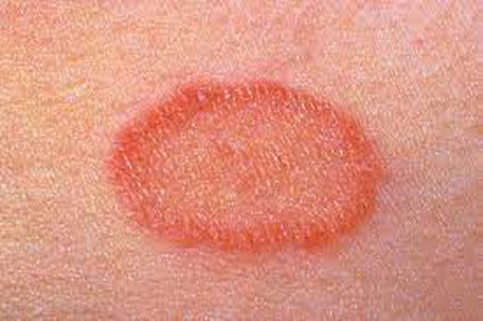 Symptoms of Pityriasis Rosacea