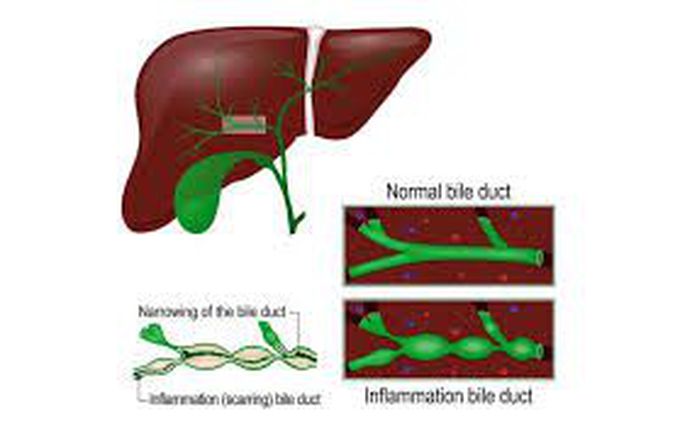 Carolis disease