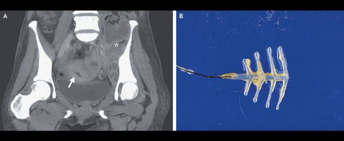 Abdominopelvic Actinomycosis