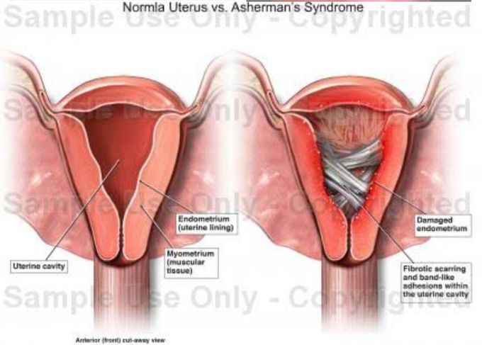 Asherman syndrome