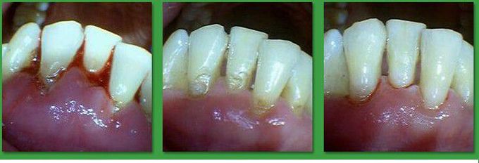 Cause of Periodontitis