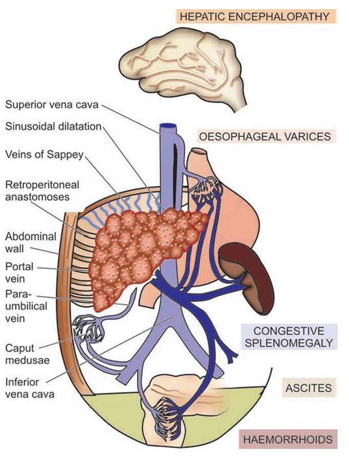 Portal hypertension