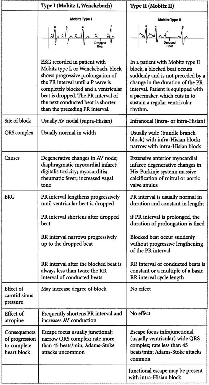Second Degree Heart Block- Mobitz I vs Mobitz II