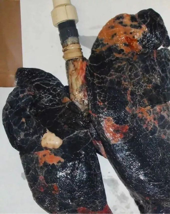 Smoker's Lungs