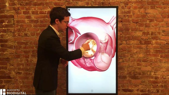 What is aortic stenosis?