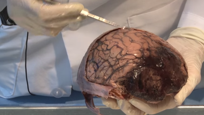 Sub-dural Haematoma