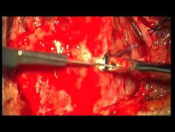 Retrosigmoid approach for resection of petrous apex meningioma