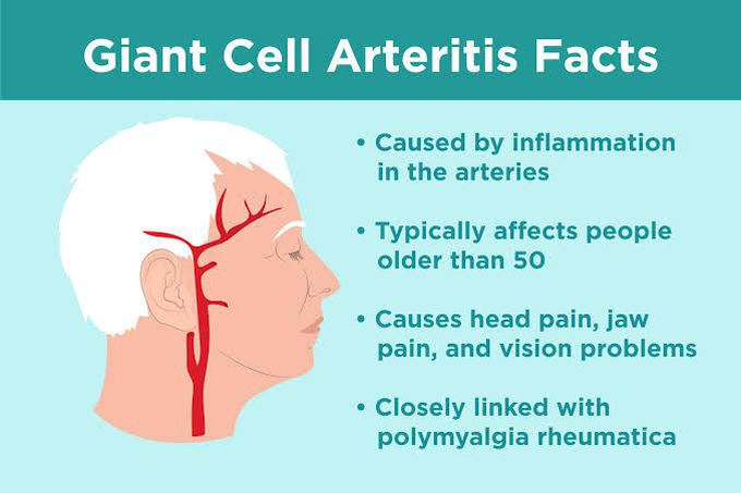 Giant cell arteritis