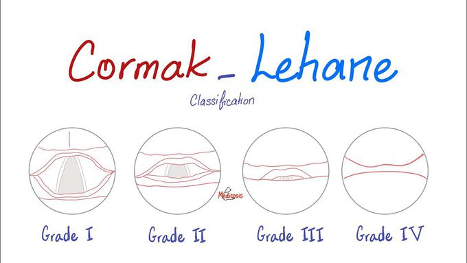 Cormak-Lehane Classification (Grades) for Airway Management and Endotracheal Intubation