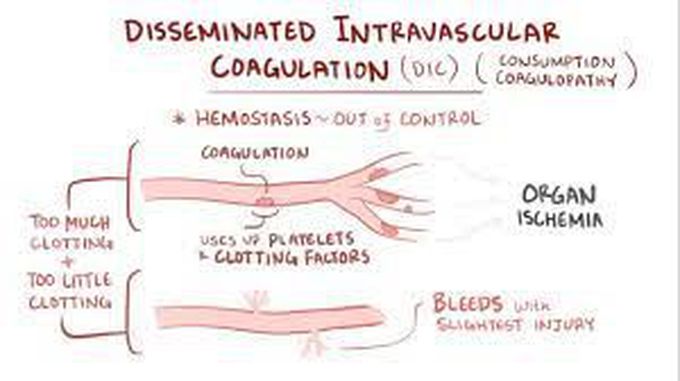 Disseminated Intravascular Coagulation