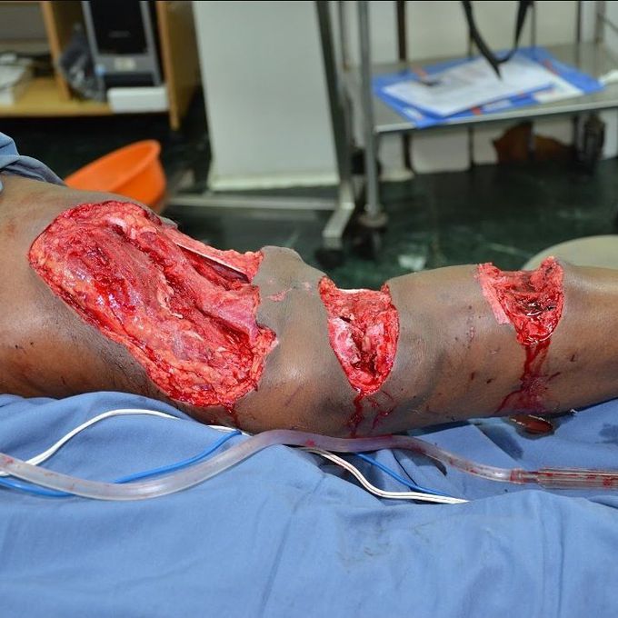 An awful case of a crush injury
