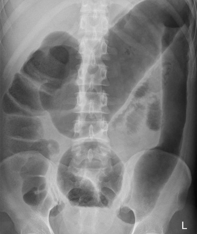 Toxic Megacolon