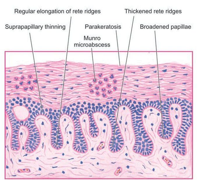 Psoriasis