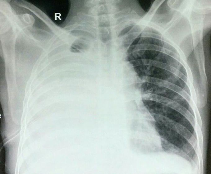 Pls interpret the chest x ray