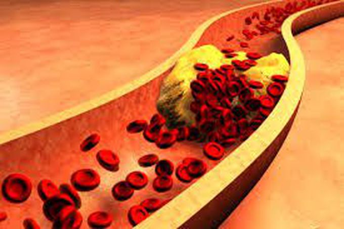 What is hyperlipidemia