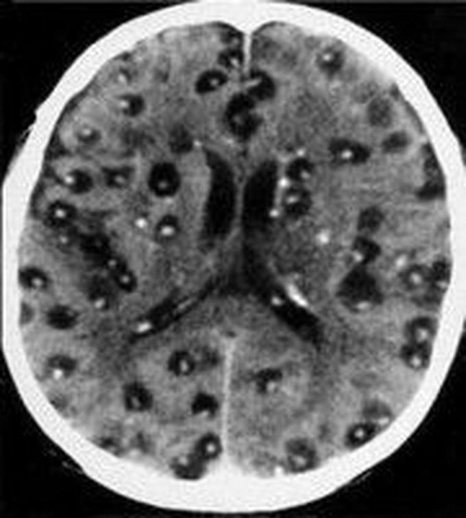 Neurocysticercosis