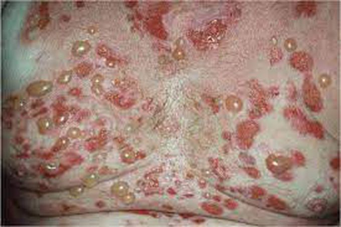 Bullous Pemphigus