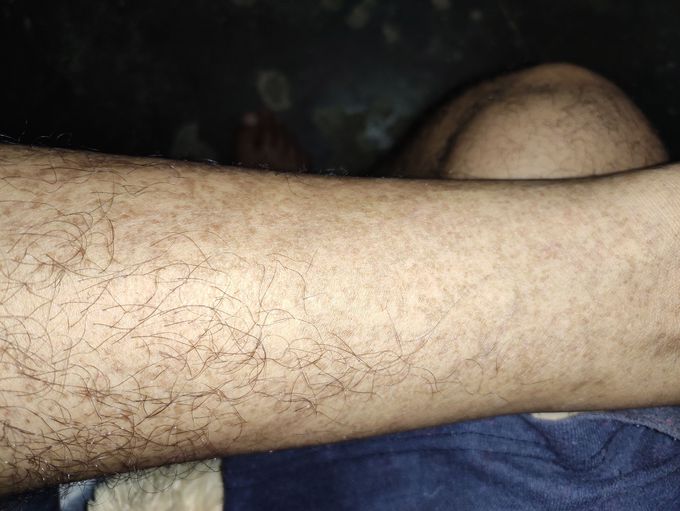 What is this and treatment