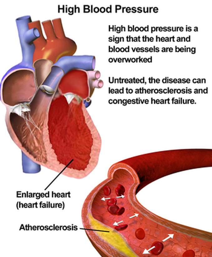 Risk factors of hypertension