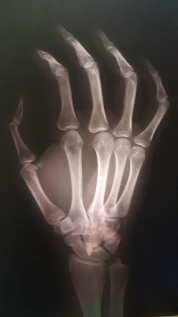 Xray result